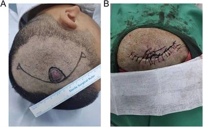 Geometrical model establishment and preoperative evaluation on A-T flap design: Finite element method-based computer-aided simulation on surgical operation processes